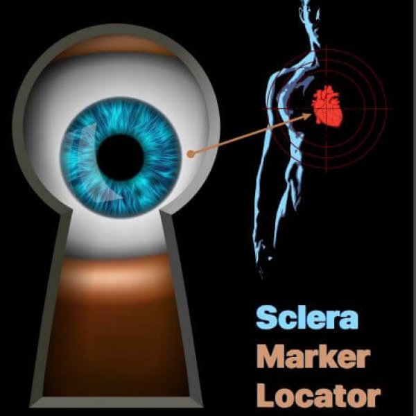 Sclera Marker Locator